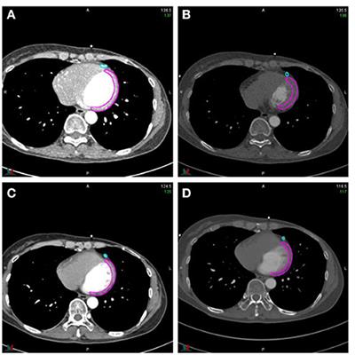Study on the Effect of 4D-CT Special Reconstruction Images for Evaluation of the Cardiac Structure Dose in Radiotherapy for Breast Cancer
